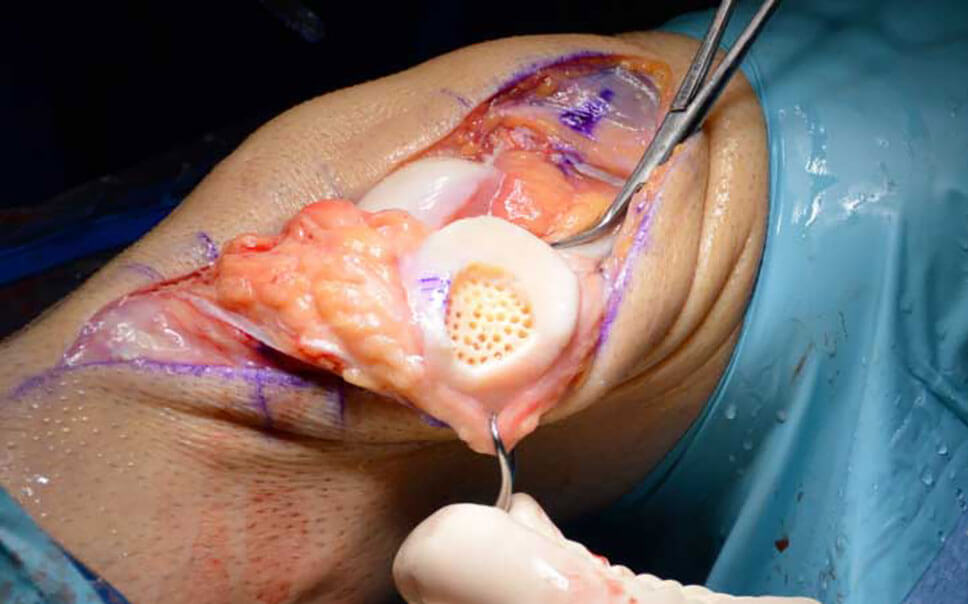 Knee open in an operating room showing damaged cartilage.